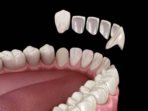 veneer